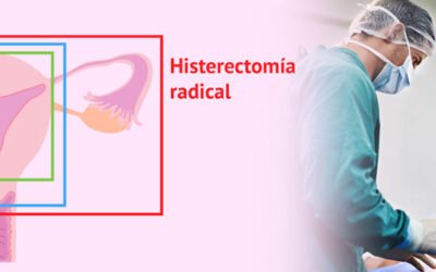 HISTERECTOMÍA RADICAL – ACTA CANCEROLÓGICA